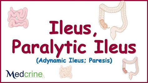 Paralytic Ileus : causes, pathophysiology, clinical features, diagnosis ...