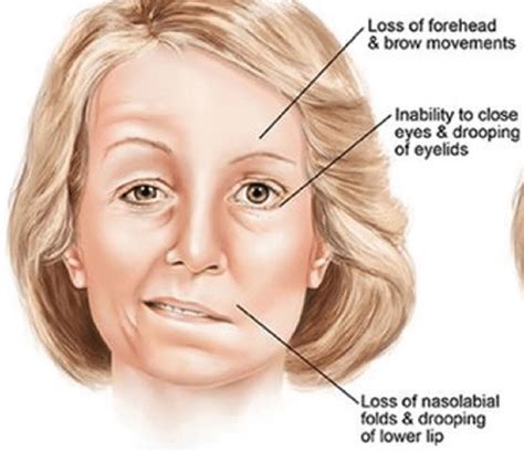 Bell's Palsy Treatment / Bell's Palsy Treatment - At Home Moxibustion ...