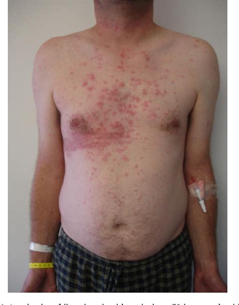 Figure 2 from A rare case of disseminated shingles in an ...