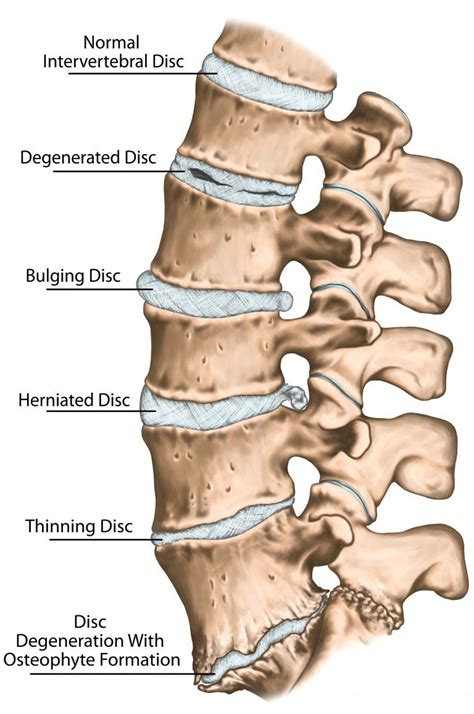 Can Cannabis Help With Intervertebral Disc Disease?