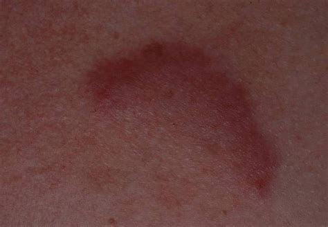 Lupus erythematosus tumidus (tumid lupus) - Dermatology Advisor