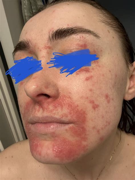 Desperate for help with my granulomatous rosacea : r/Rosacea