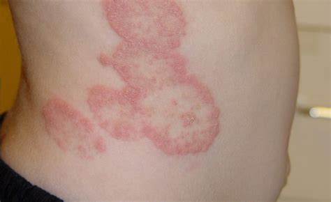 6 Painful Fungal Infections: Causes, Symptoms, and Treatments