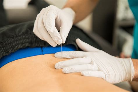 Dry Needling for Pain Relief: A New Tool for Your Pain Toolkit - Life ...