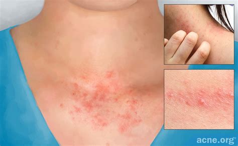 Contact Dermatitis: Signs, Symptoms, And Complications, 46% OFF