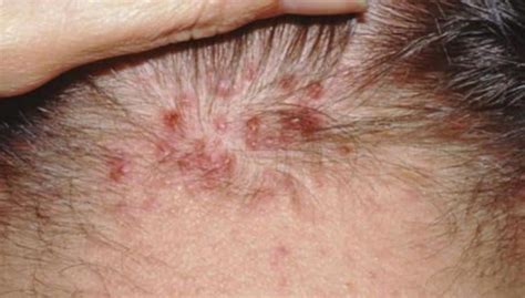 Scalp Acne Causes, Treatment & Remedies with Pictures - Strong Hair