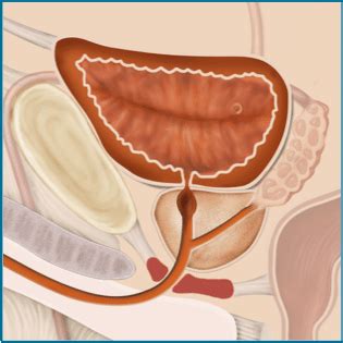 Bladder neck stricture | Symtoms & treatment | Memokath™