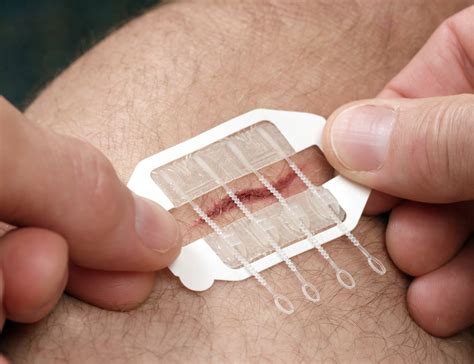 ZipStitch Is a Wound Closure Device that Works in Seconds