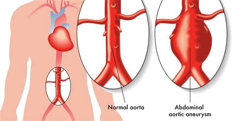 Abdominal Aortic Aneurysm (AAA) - familydoctor.org