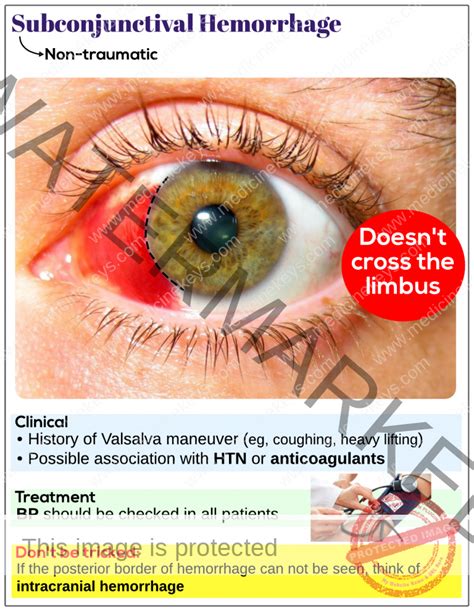 Subconjunctival hemorrhage (non-traumatic) - Medicine Keys for MRCPs