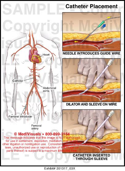 Femoral Catheter Placement Medical Illustration Medivisuals