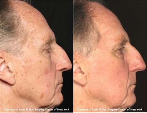 Actinic Keratosis Skin Guide New York, NY | Laser Center