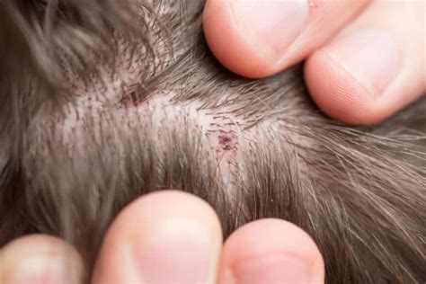 Scabs and Sores on Scalp: 17 Causes, Pictures and Treatment