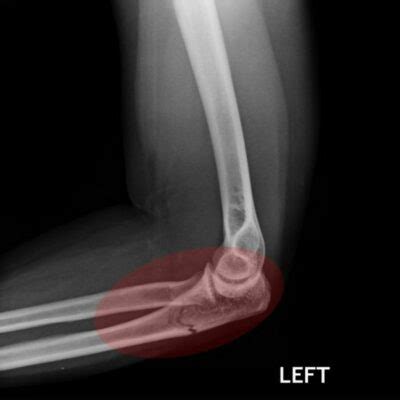 Fracture of the Elbow Area | Elbow Specialist | South Windsor, Enfield ...