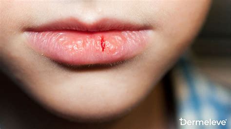 Eczema On Lips - Lip Dermatitis Triggers And Best Treatment – Dermeleve®