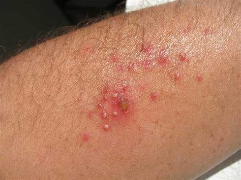 Skin Fungal Infection Pictures / Fungal Infection: Definition, Symptoms ...