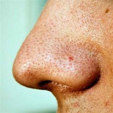 Infected Blackheads - Pictures, Symptoms, Causes, Treatment