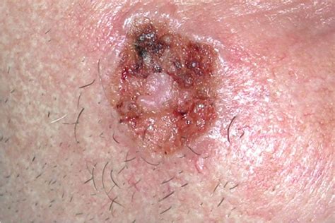 Basal Cell Carcinoma - Treatment