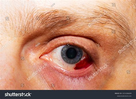 Hemorrhage Eye Rupture Vessel Eye Blood Stock Photo 2231266699 ...