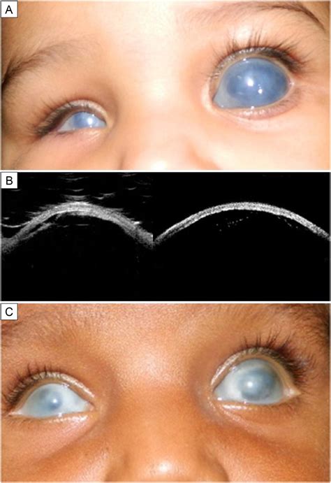 Primary aphakia: clinical recognition is the key to diagnosis - Journal ...