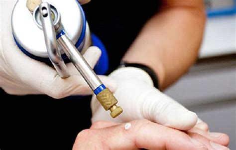 Cryosurgery Treatment | Skin Lesions | Dermatology Clinic Birmingham