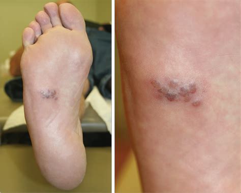 A 55-Year-Old Man With a Painful Rash on the Sole of His Foot ...