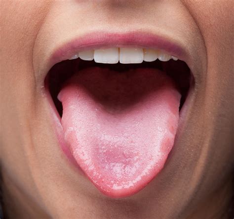 Tongue Disorders: MedlinePlus