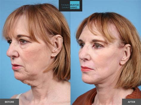 8 Facelift Before-and-After Photos That Prove Just How Natural Today’s ...