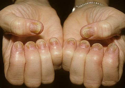 Nail psoriasis pictures | Symptoms and pictures