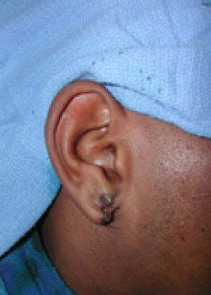 Keloid Removal Archives - Rhinoplasty Institute of Chicago