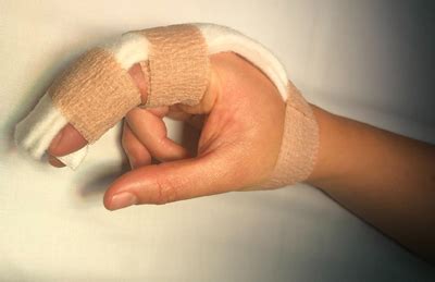 Distal Phalanx Fracture Splint