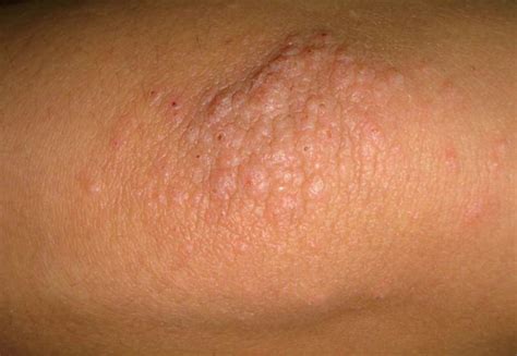 Cluster Of Bumps On Elbow Images, Photos | Mungfali