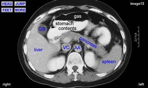 normal CT abdominal with label