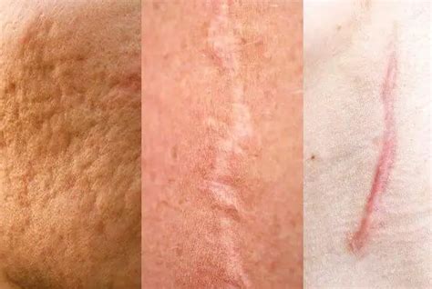 Atrophic scars: causes, treatment | Health 2024