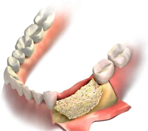 Bone Grafting for Dental Implant: 6 Types Of Bone Graft