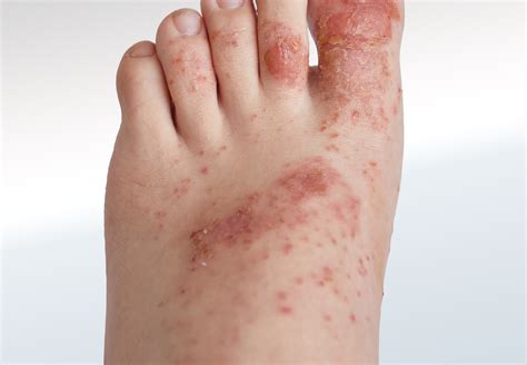 Dark Red Rash On Top Of Foot Sale Online | emergencydentistry.com