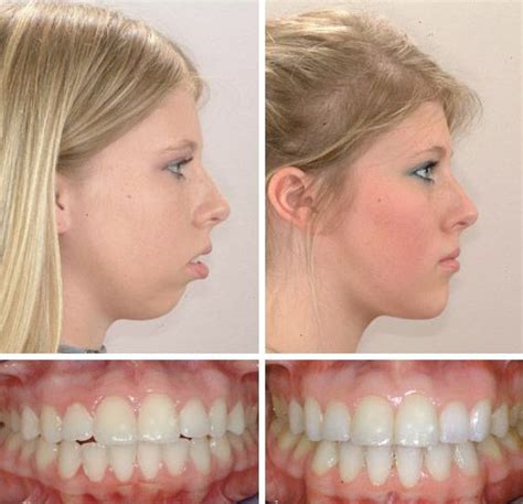 Braces Jaw Overbite Before And After | Before And After