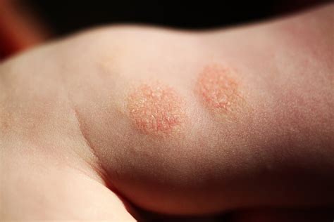 Eczema in Kids: What Parents Can Do to Calm the Itch