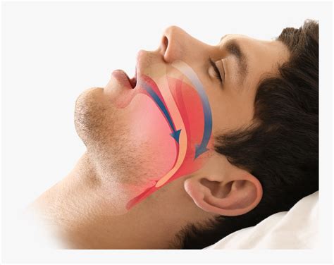 Obstructive Sleep Apnea (OSA) Treatment Options - CPAP