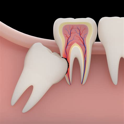 Tooth Extractions – Kenilworth, IL – Glenview, IL – Evanston, IL