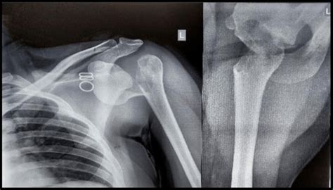 Radiograph AP and axial view of right shoulder. | Download Scientific ...