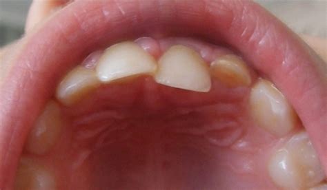 Intraoral view of the laterally luxated tooth showing the luxation in ...