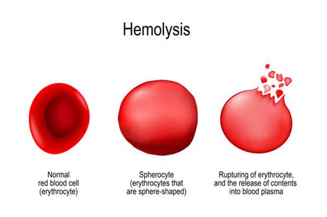 200+ Hemolysis Stock Photos, Pictures & Royalty-Free Images - iStock