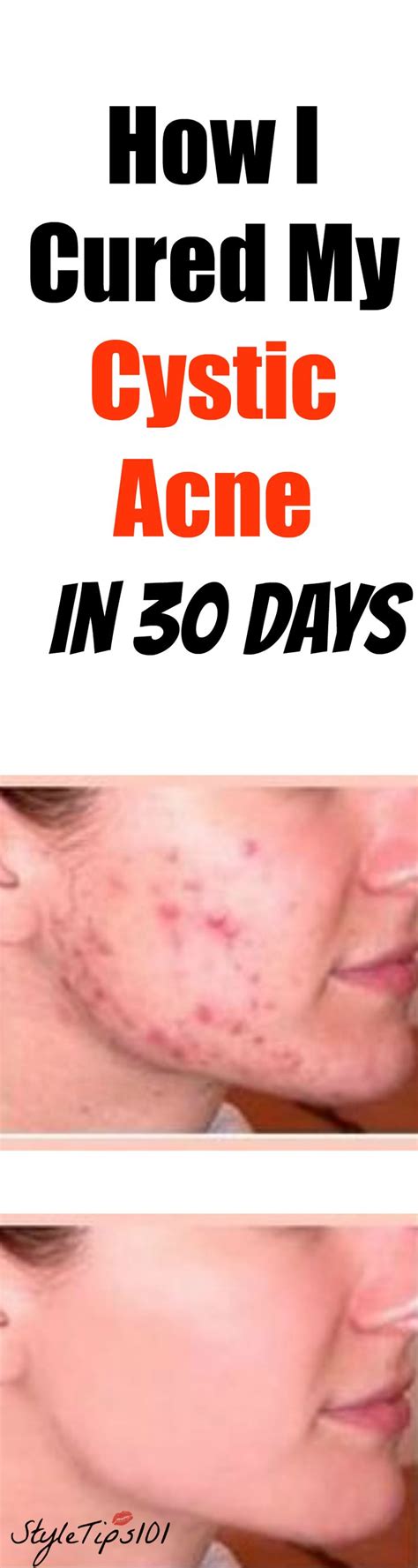 4 Ways To Get Rid Of Cystic Acne Scars - Acne Face Scars