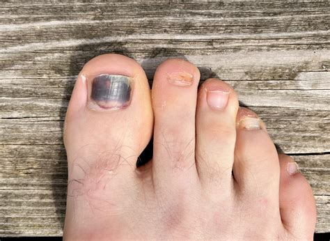 Black Toenail: Causes, Treatment, and Prevention Tips - Feet First Clinic