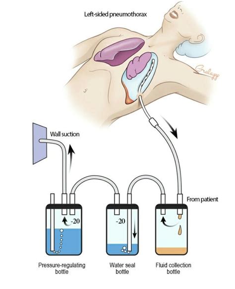 Chest Tubes | 9 System Review | Nursing school pharmacology, Nursing ...