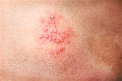 At-Home Treatments for Shingles | PainScale