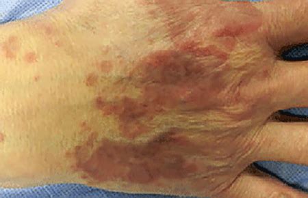 Granuloma annulare: Signs and symptoms