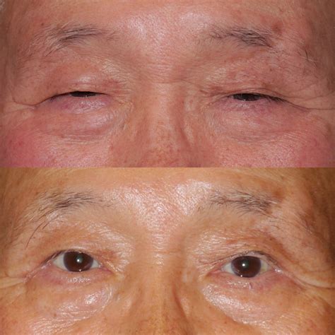 Ptosis Surgery Arlington & Tyson VA