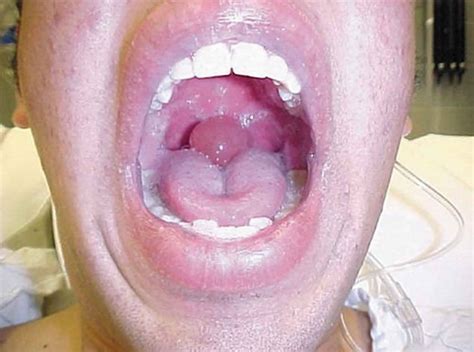 Uvula Cancer